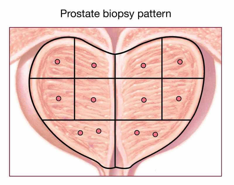 mr-ultrasound-fusion-guided-biopsy-of-the-prostate-a-better-way-to