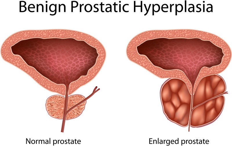 Enlarged Prostate