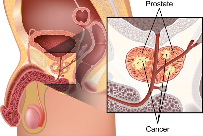 Prostate cancer